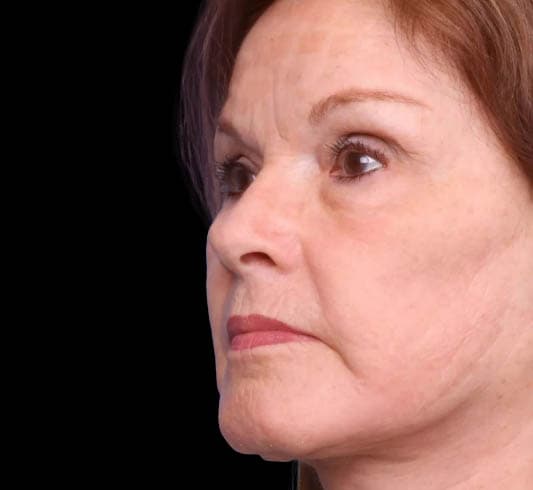 Deep Plane Facelift After Image