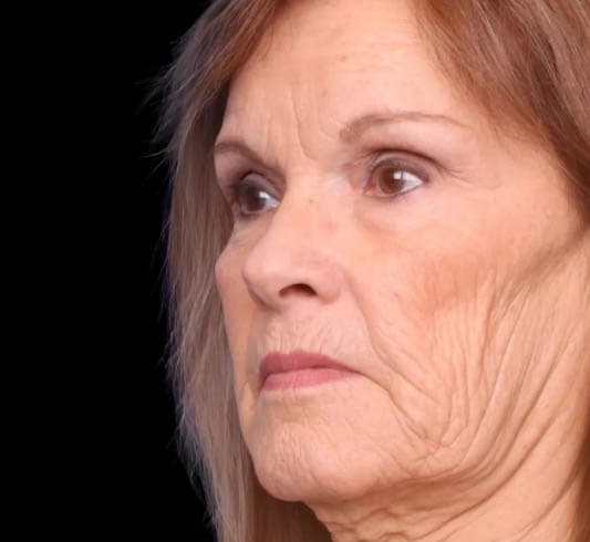Deep Plane Facelift Before Image
