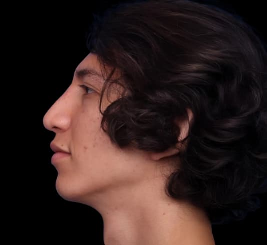 Ethnic Rhinoplasty After Image