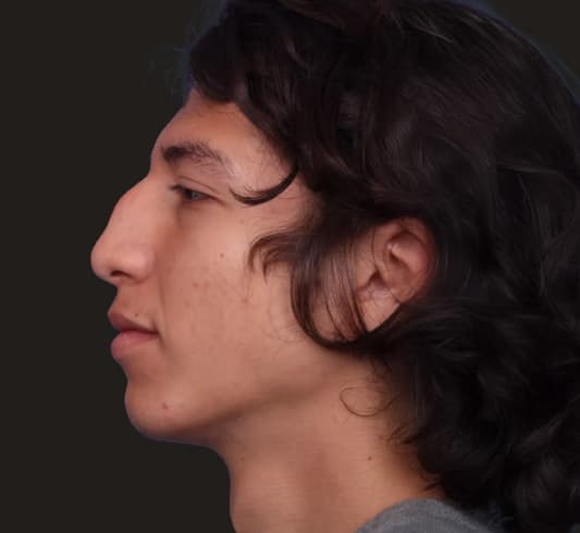 Ethnic Rhinoplasty Before Image