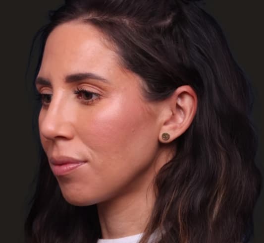 Rhinoplasty After Image
