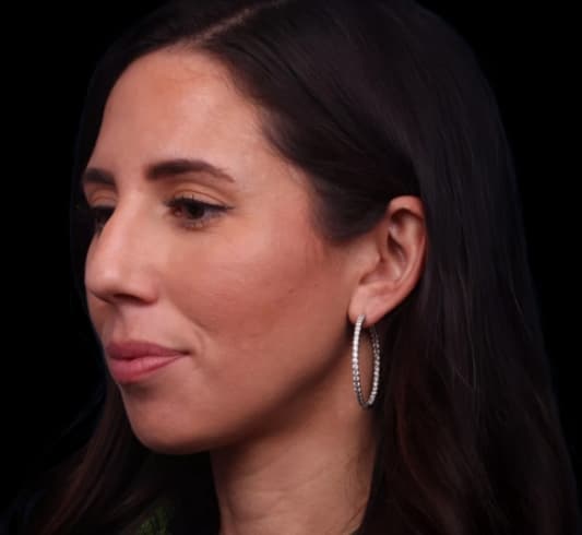 Rhinoplasty Before Image