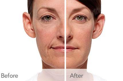 Radiesse Before and After Photos in Scottsdale