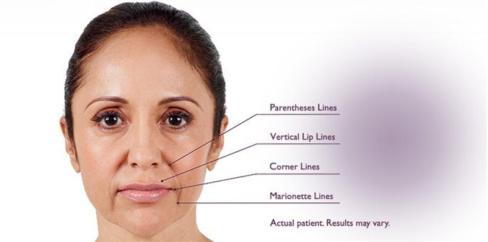 Juvederm Injections in Scottsdale