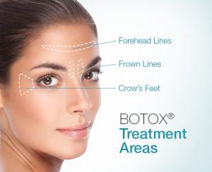 Botox Treatment Areas in Scottsdale