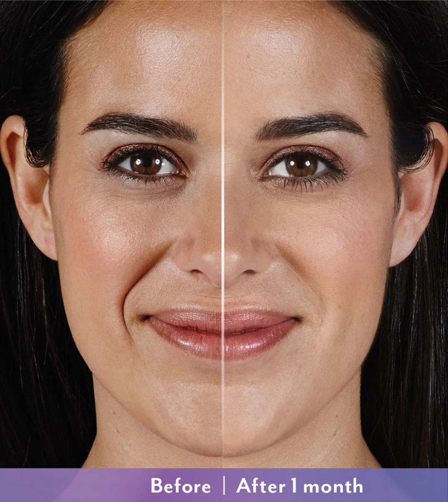 Juvederm Treatment After