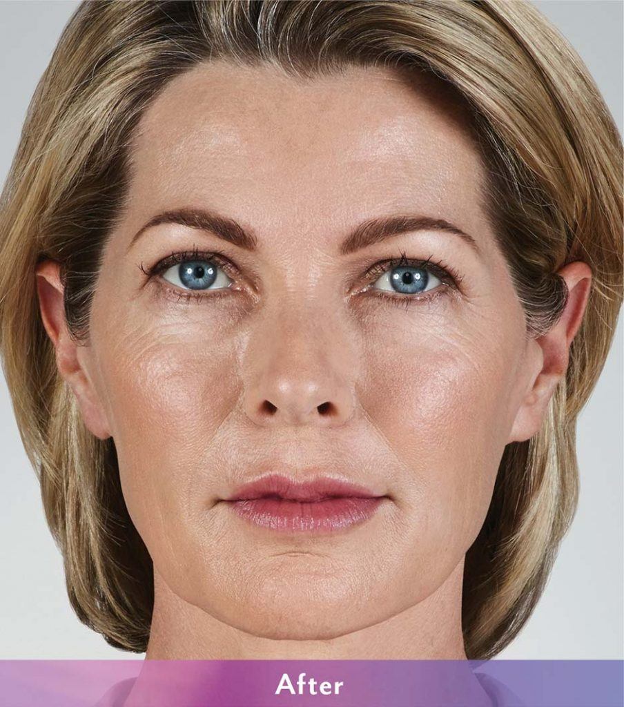 Juvederm Treatment After Photo