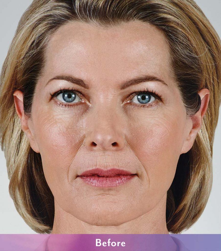 Juvederm Treatment Before Photo