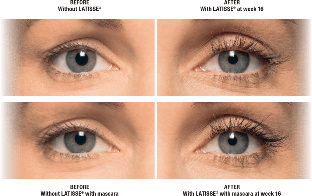 Before and After Eyelash Improvement with LATISSE