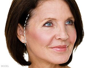 facelift incision