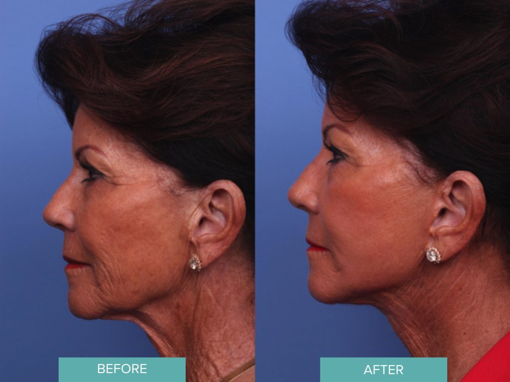 Facelift Before and After Photos