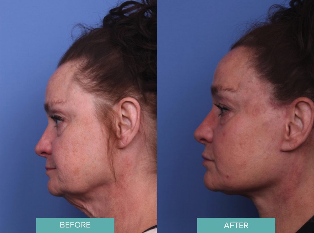 Facelift Before & After Case 415