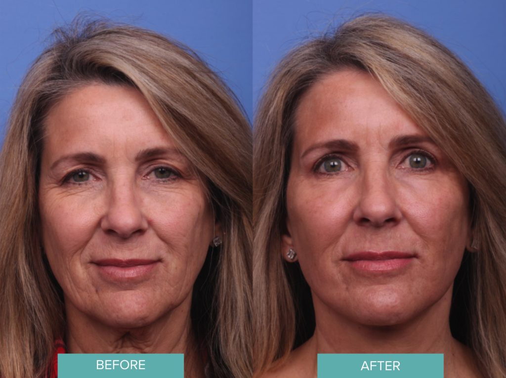 Facelift Before & After Case 191