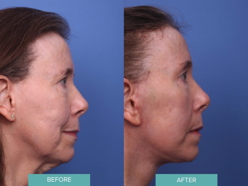 Facelift Before & After Case 257