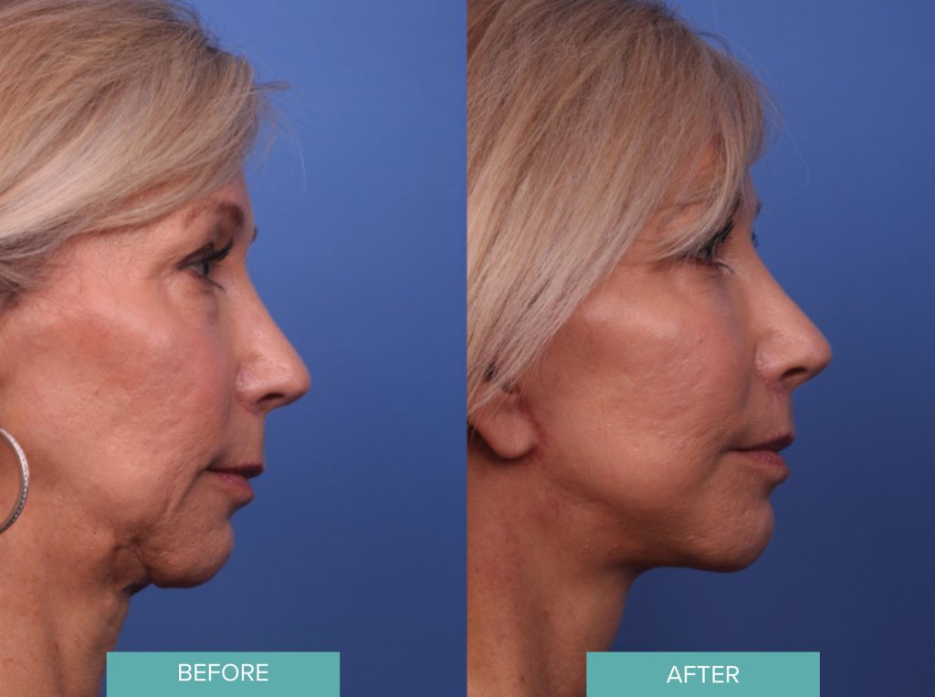 Facelift Before & After Case 267