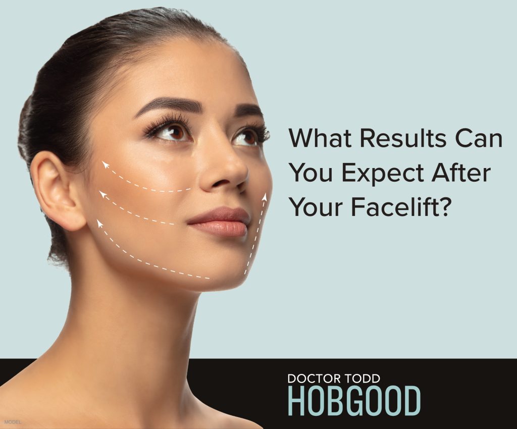 Woman with beautiful and youthful kin with arrows pointing up (model) and text that reads What Results Can You Expect After Your Facelift?