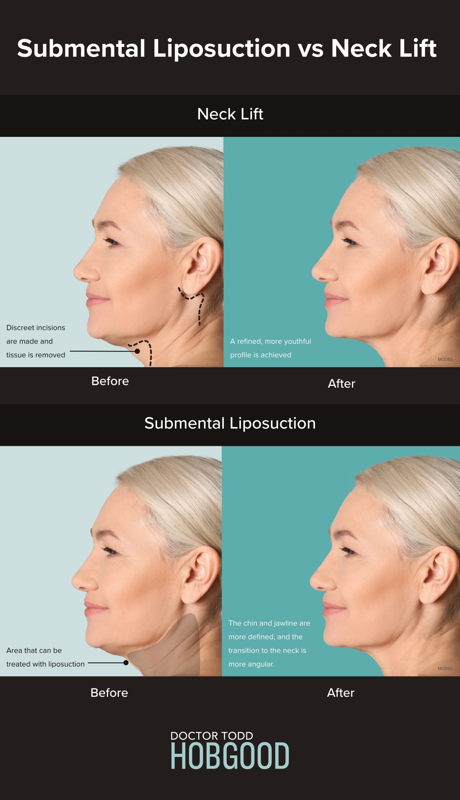Infographic that illustrates steps in submental liposuction vs neck lift (model)
