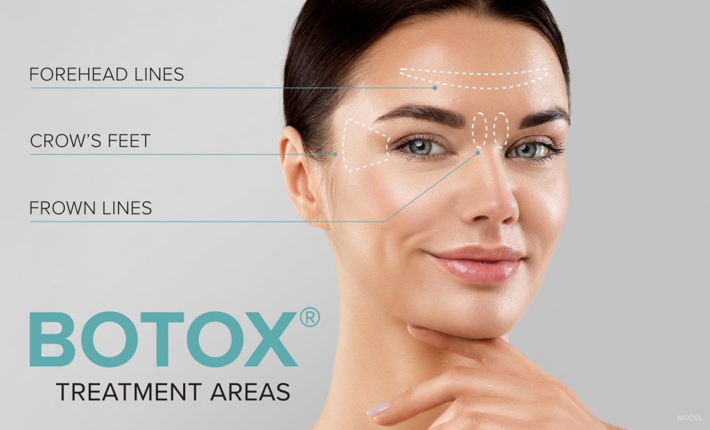 botox diagram of treatment areas