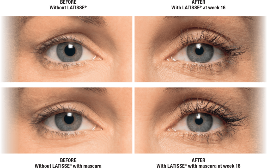 before and after Latisse results